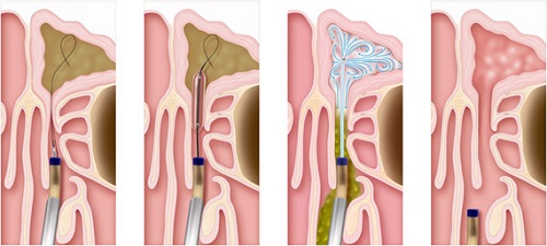 Balloon Sinuplasty Balloon Sinuplasty